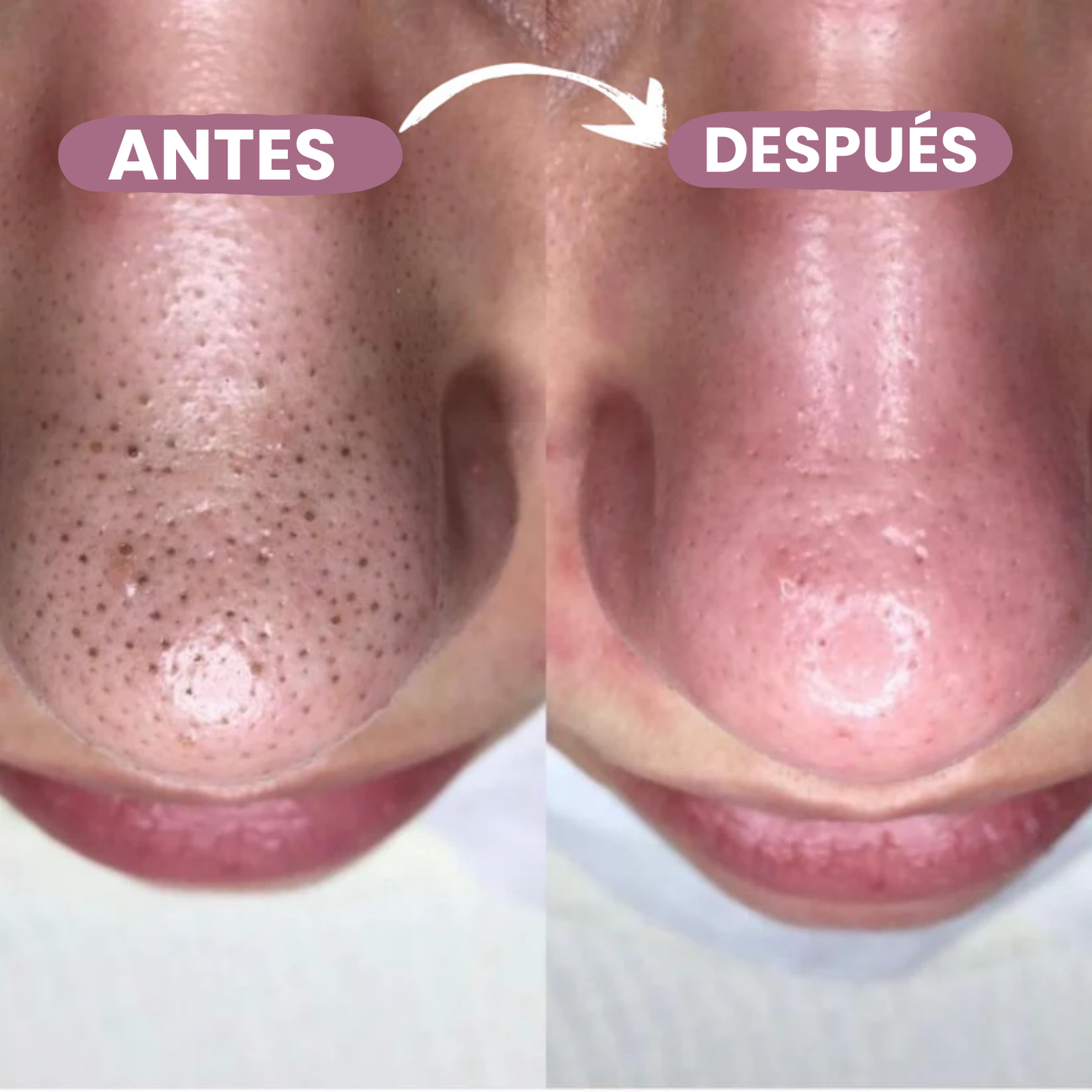 Peel Shot Exfoliante De Arroz Anti-Puntos Negros - 80ml